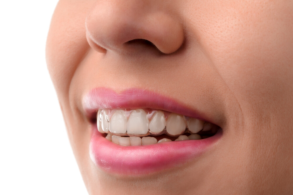 Dental Health while wearing Invisalign & How to Maintain It?