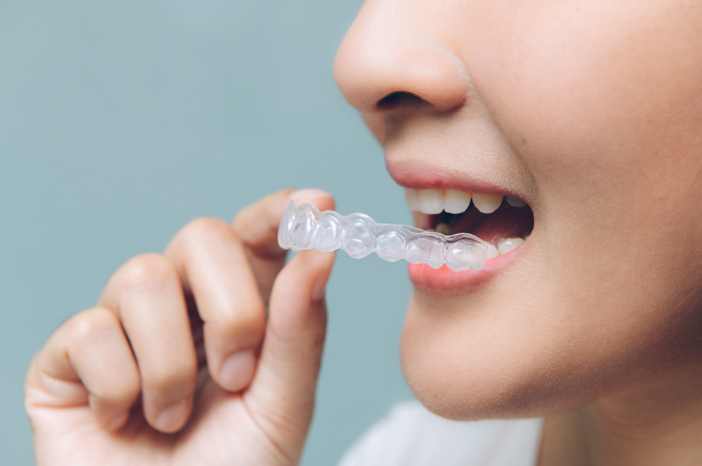 Tips and Tricks for Maintaining Oral Health While Using Clear Aligners