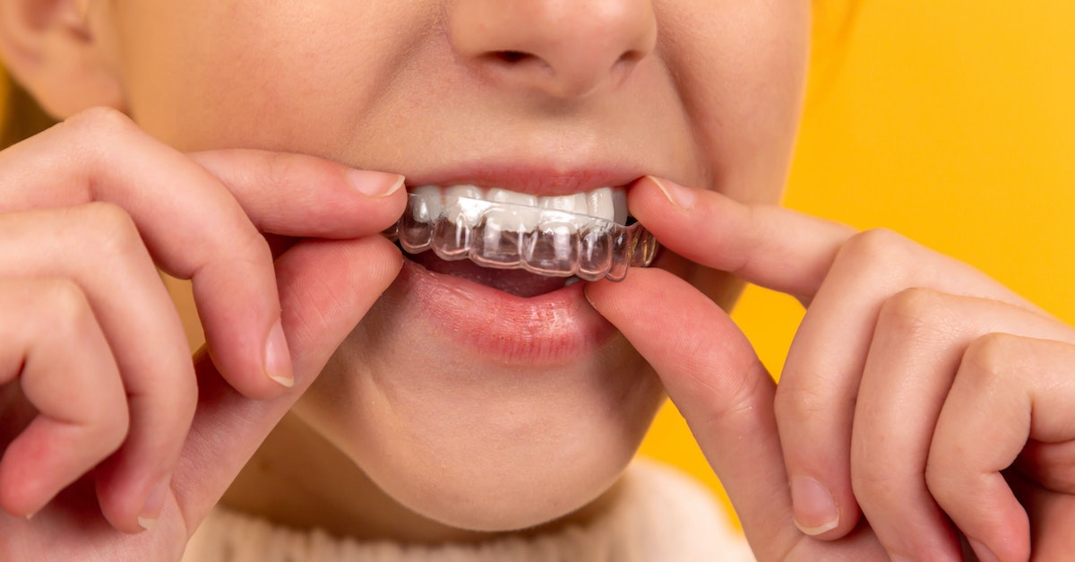 5 Common Myths About invisalign aligners