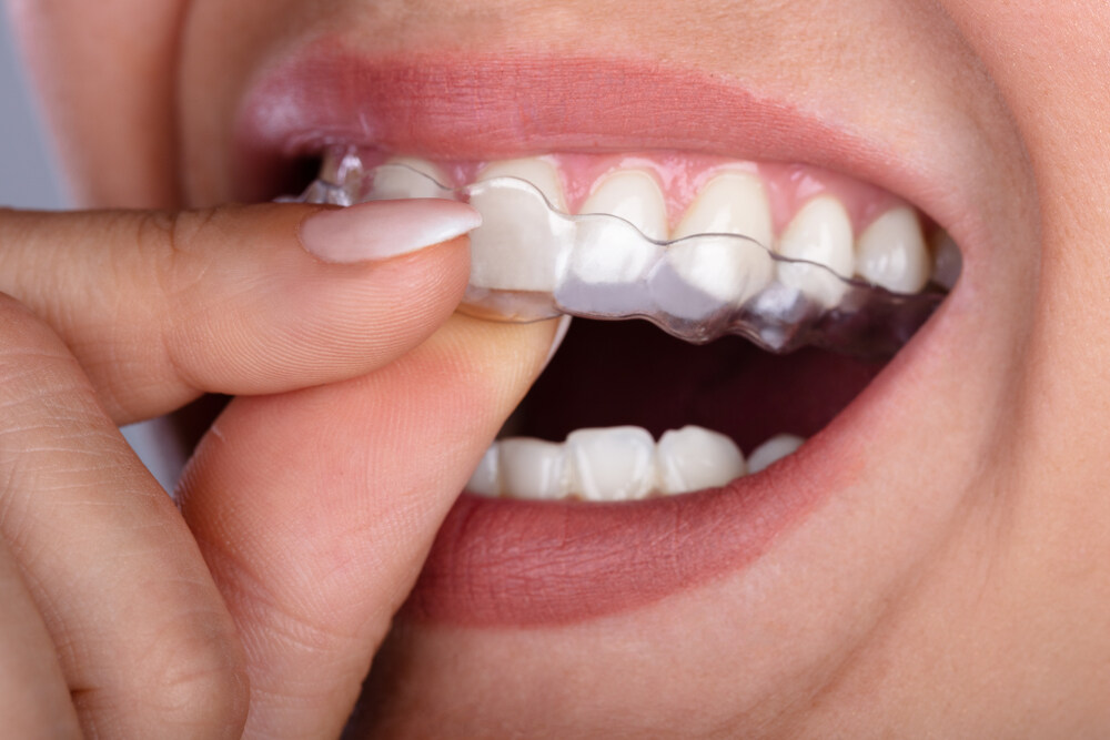 Clear Aligner For Teeth & How Long It Takes Them to Start Working?