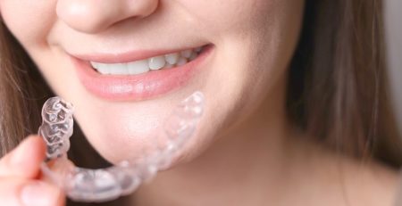 Clear Aligners