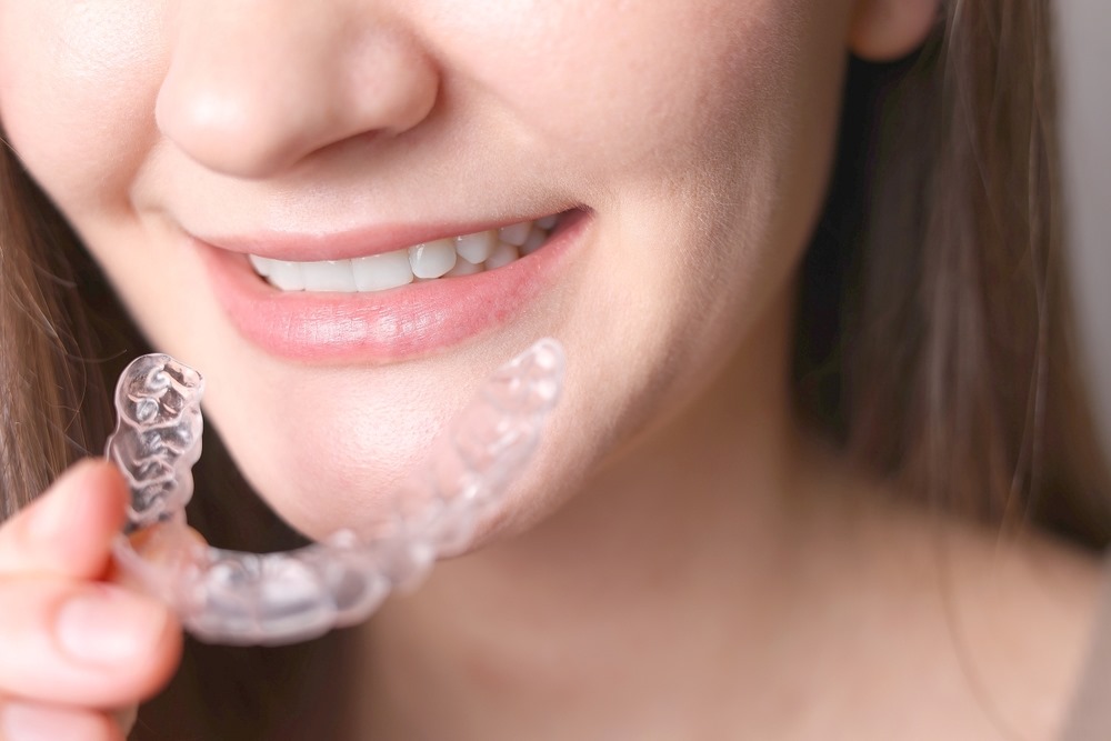 Clear Aligners