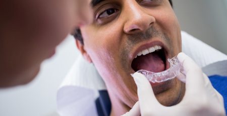 Clear Aligners